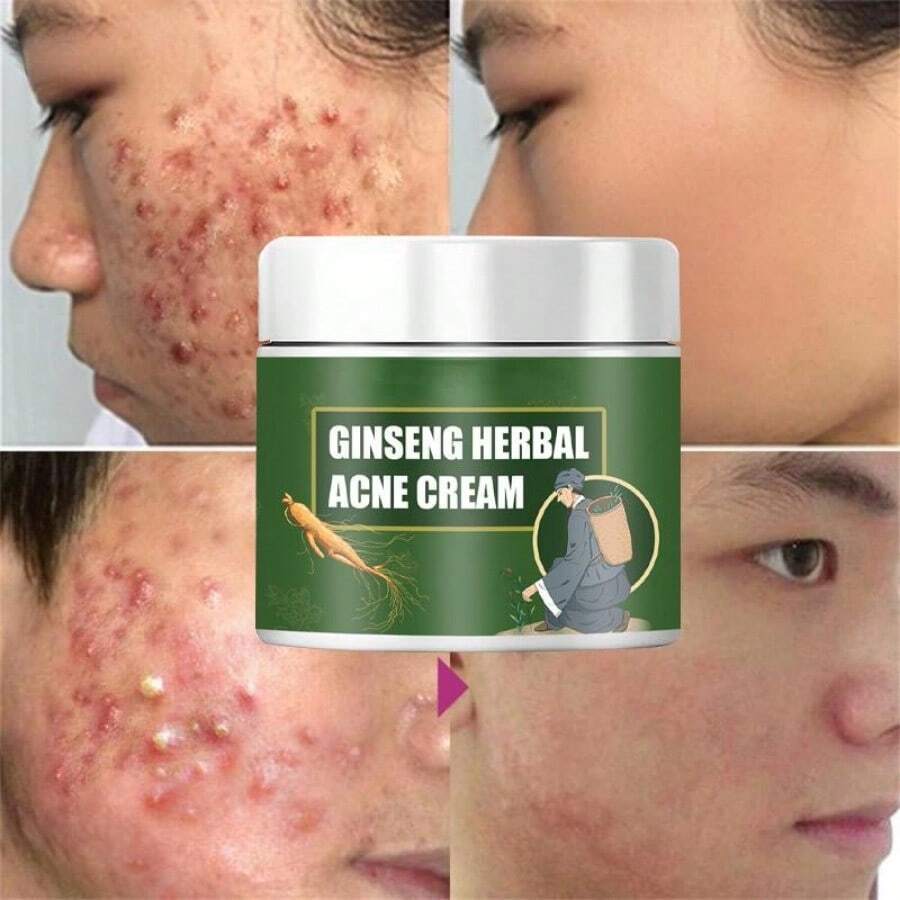 Crema Efectiva Para Tratamiento De Eliminación Del Acné, Cicatrices Y Reducción De Poros. Con Control De Aceite, Blanqueamiento Y Humectante Facial.