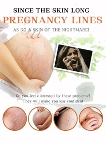 AuQuest 妊娠紋霜，產後修復霜快速吸收妊娠紋修復霜適合孕婦有妊娠紋和肥胖紋淡化疤痕