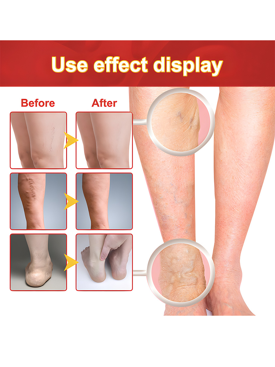 Varicose Veins Treatment Leg Heating Patch Strengthen Capillary Health And Improve Blood