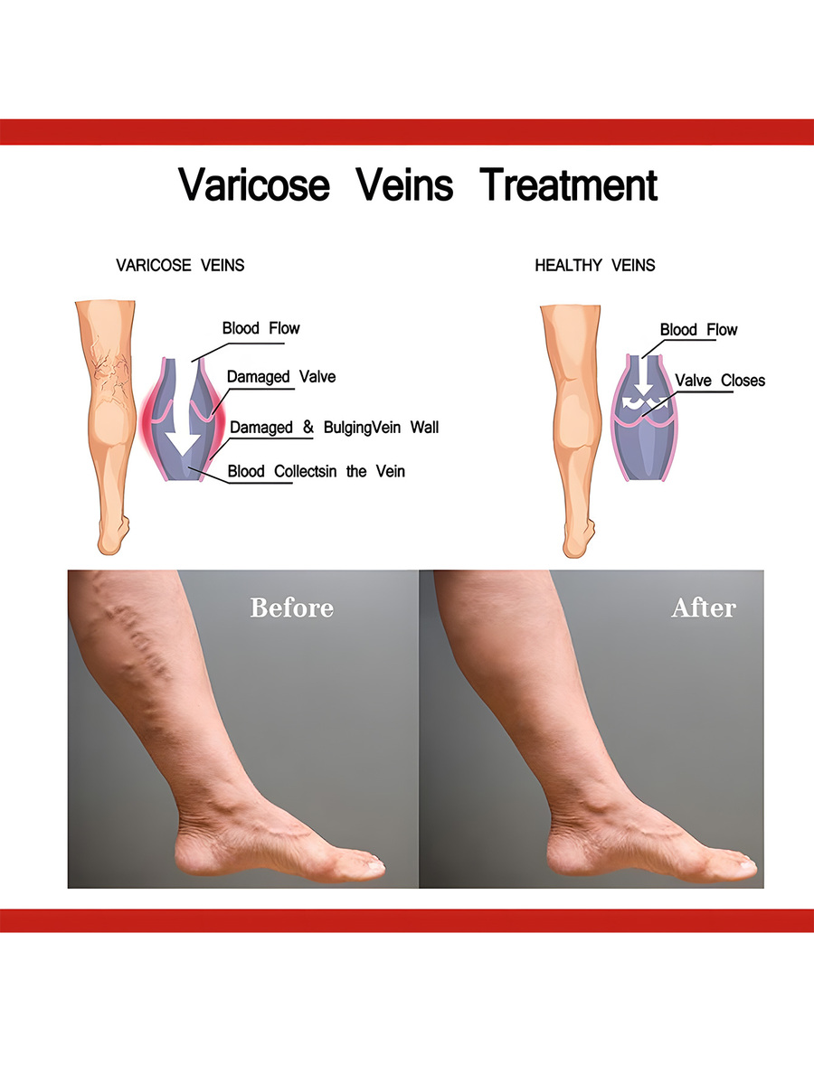 Varicose Veins Treatment Leg Heating Patch Strengthen Capillary Health And Improve Blood