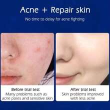 SENANA-Crema para el tratamiento del acné,  para eliminar la espinilla , crema antiacné para todo tipo de piel 30g - Azul - Ver 3