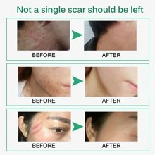 Scar Removal Cream 50ml - White - View 3