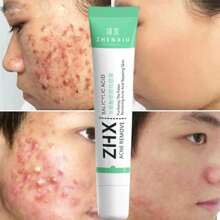 Azelaic Salicylic Acid Cream Kit Anti-Acne Anti-Stain Removes Blackheads - 彩色 - 查看 2