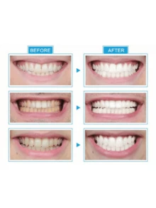Kit de Blanqueador Dental con frío luz azul , incluye dental Guardia con blanqueador - Blanco - Ver 6