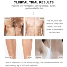 1入組除毛器,升級版至閃爍帶冰功能,適合男士&女性,無痛&持久效果臉部,腋窩,腿和比基尼泳裝區域,帶保護眼鏡 - 白色 - 查看 3