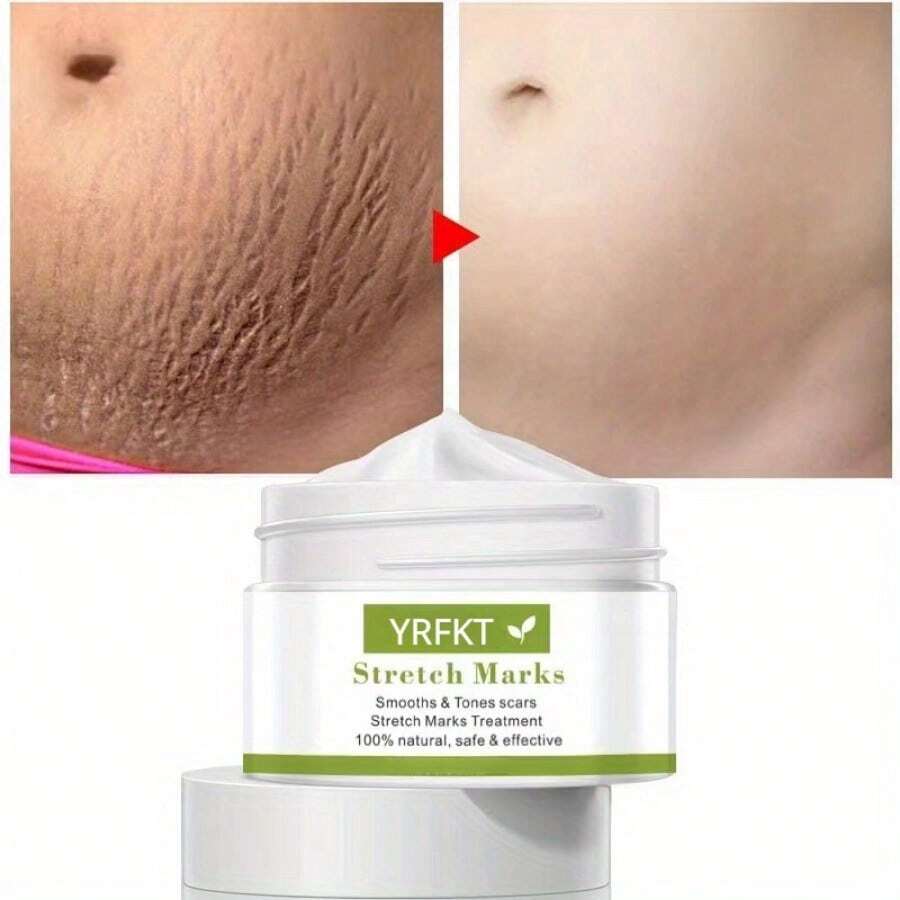 Say Goodbye to Stretch Marks with Our Powerful Fade Cream for Sale