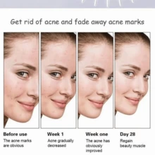 Serum  Anti Acné Piel Delicada Puntos Anti-manchas 30ml con extracto de aloe vera y acido salicilico - transparente - Ver 5