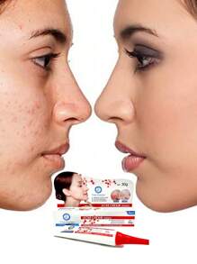 Tree Doctor Esencia De Crema Acne Crema Anti Acné Control De Grasa Piel Quita Manchas Provocadas Por El Acne - Blanco - Ver 2