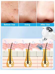 HYUNDAI 六合一便携式电动黑头吸出器套装，三种模式，USB充电式黑头吸出器，面部毛孔清洁器，面部及皮肤护理工具 - 白色 - 查看 2