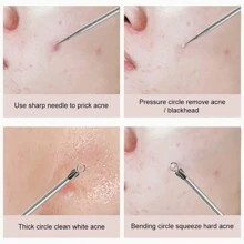 Professional Acne Removal Tool Kit, Blackhead Extractor, Pimple Popper, Comedone Extractor, Stainless Steel Acne Remover Tweezers, With Loop Facial Tool For Removing Blackheads - Silver - View 9