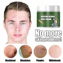 Crema Efectiva Para Tratamiento De Eliminación Del Acné, Cicatrices Y Reducción De Poros. Con Control De Aceite, Blanqueamiento Y Humectante Facial.