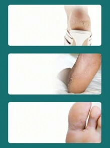 1set Foot Callus Remover, Exfoliating Scraper For Dead Skin & Calluses, Foot Care Tool For Daily Use At Home,Bag,Organizer,Storage