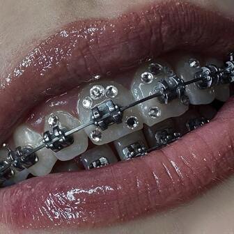 40 件闪亮透明牙齿宝石套装，水钻牙齿时尚装饰，DIY 牙齿配件，男女通用（不含胶水）