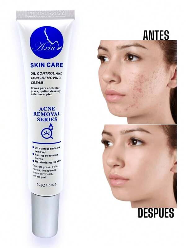 Tratamiento Acné Crema Facial Contra Erupciones de Acné Leves y Moderadas Elimina la presencia de Granos en el Rostro Hidrata tu Piel y Mantiene Limpia para Evitar Acumulación Posterior Regula Grasa y Aceites del Rostro Crema 30g