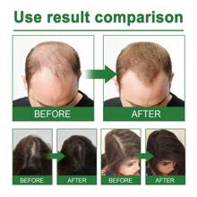 1 件迷迭香头皮护理喷雾，含薄荷油按摩头皮护发精华，健康头发从发根渗透到发梢（30 毫升/1 液量盎司） - 1 bottle - 查看 7