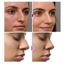 Nose Shaping Device - Nose Contour Firming Device To Lift Bridge And Define Nose Shape - White - View 4