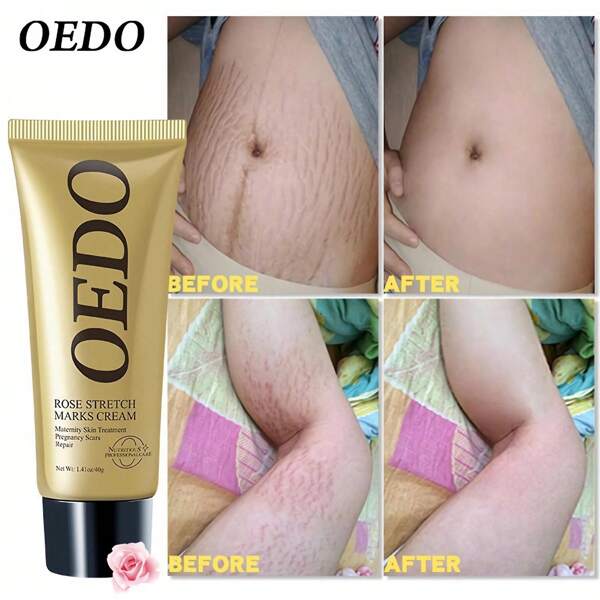 Stretch Mark Essential Removal Cream Pregnancy Repair Scar Slack Line Abdomen,Rose Cream Eliminates Stretch Marks, Nourishes And Maintains The Cream