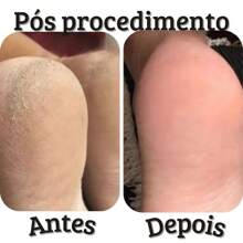 Kit Repos Amaciante Amolecedor de Calos Calosidades e Cutículas Creme Esfoliante Parafina Espátula Plantar 222 Botinha Descartável - Spa dos Pés - Branco - Visão 6