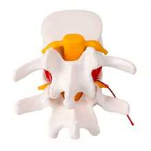 Human Anatomical Lumbar Disc Herniation Model - Lumbar Spine Model For Teaching & Learning - Excellent Way For Demonstrating Disc - White - View 5