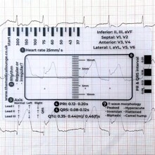 Acrylic Medical Ruler, 7-Step Diagnostic Guide, Waveform Measurement Tool For Cardiac Reading And Analysis