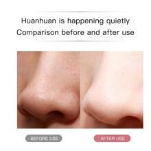 Ultrasonic Skin Scraping Pore Cleansing Device, Unisex Facial Deep Cleansing Beauty Tool