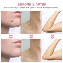 2-8mm Auto Skin Tag Remover Kit - Painless,And Safe 2-In-1 Skin Tag Removal , Including Face, Neck, And Body,Gentle, And Safe For Most Body Parts - 粉色 - 查看 2