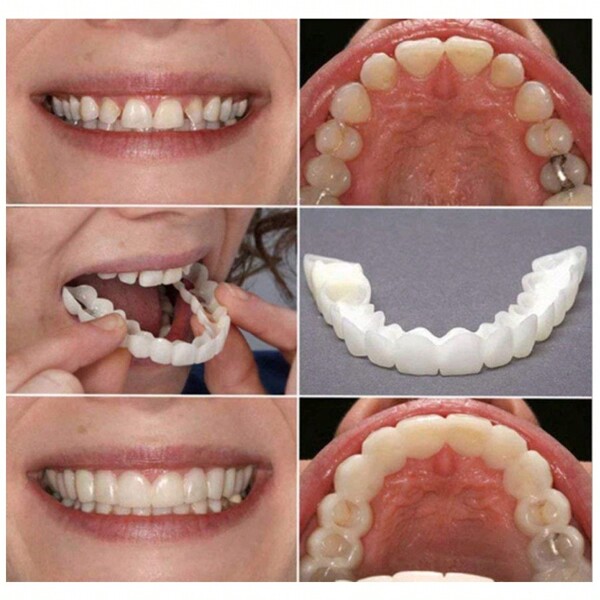 2 pezzi Apparecchi ortodontici dal colore naturale che aiutano a ottenere un sorriso perfetto, adatti per varie occasioni: per attività sociali, per diverse forme di denti, universali, facili da installare