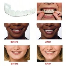 2 pezzi Apparecchi ortodontici dal colore naturale che aiutano a ottenere un sorriso perfetto, adatti per varie occasioni: per attività sociali, per diverse forme di denti, universali, facili da installare