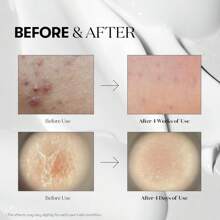 suero de microagujas para uso diario y nocturno con exosomas, centella asiática, ácido hialurónico, propóleo, piel suave, regeneración, piel de cristal, potenciad - Blanco - Ver 4