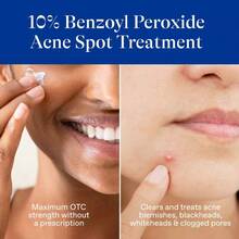10% Benzoyl Peroxide Acne Spot Treatment