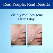 10% Benzoyl Peroxide Acne Spot Treatment