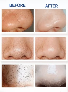 黑头真空吸出器，强力便携式面部毛孔清洁器，配备4个吸头，温和去除黑头，无需挤压，男女皆宜。您的专属专业美容师。 - 彩色 - 查看 2