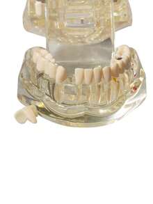 1pc Dental Implant Model, Pathological Tooth Model, Detachable Oral Model, Bridge Demonstration Model For Dental Care - 1PC - View 2