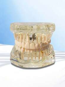1pc Dental Implant Model, Pathological Tooth Model, Detachable Oral Model, Bridge Demonstration Model For Dental Care - 1PC - View 6