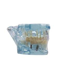 1pc Dental Implant Model, Pathological Tooth Model, Detachable Oral Model, Bridge Demonstration Model For Dental Care - 1PC - View 7