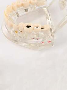 1pc Dental Implant Model, Pathological Tooth Model, Detachable Oral Model, Bridge Demonstration Model For Dental Care - 1PC - View 14