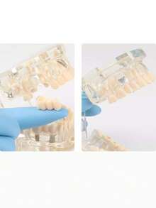 1pc Dental Implant Model, Pathological Tooth Model, Detachable Oral Model, Bridge Demonstration Model For Dental Care - 1PC - View 10