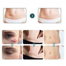 Cinta de silicona para cicatrices, láminas de silicona reutilizables para cicatrices, para diversos tipos de cicatrices como acné, estrías y otras cicatrices