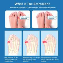 Big Toe Straightener For Men And Women, Corrector, Adjustable Bunion Splint, Toe Separator And Corrector For Bunion Relief (1 Pair) - 黑色 - 查看 10