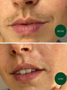 10pcs Facial Hair Removal Tool, Unisex Hair Removal Stickers, Double-Sided Hair Removal Stickers, Fast And Painless Hair Removal Kit, Suitable For All Skin Types, Suitable For Face, Legs, Arms, Armpits, Bikini Area, Eyebrows, Fast-Acting, Gentle Hair Removal, Hypoallergenic