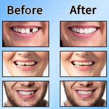 Dental Temporary Tooth Filling For Missing Broken Tooth Moldable Fake Teeth(10ml) Halloween