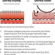 Microneedle Stamp - Microneedle Stamp For Hair, Face, Scalp, Beard - Home Microneedle Stamp - Unisex Microneedle Stamp, Titanium Microneedle Roller - Stamp Alternative - Microneedle Skincare Tool - Unisex Microneedle Roller (White) - Light Grey - View 5