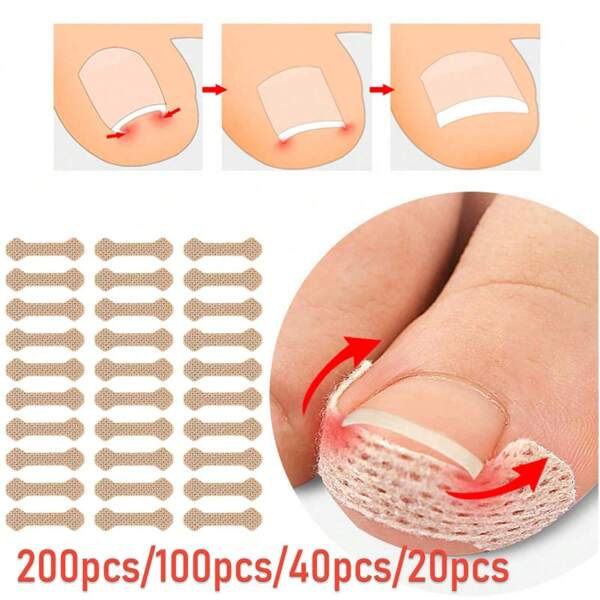 200PCS Nail Correction Stickers Ingrown Toenail Corrector Patches Treatment Recover Corrector Pedicure Care Tool