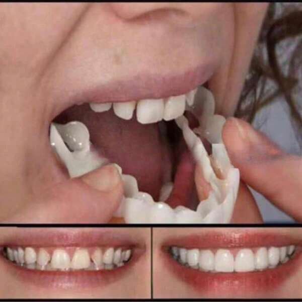 Easy-To-Use Dental Veneer Set - Durable Plastic Dental Aligners For Upper And Lower Teeth Alignment, Fashion Accessories