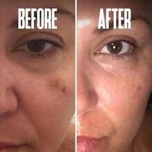 2pcs Dark Spot Corrector, Dark Spot Remover For Face - For Stubborn Dark Spots Serum, Dark Spot Remover With Kojic Acid, Alpha Arbutin, Mulberry Extract, Brightening Discoloration Correcting Serum - 彩色 - 查看 6