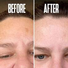 2pcs Dark Spot Corrector, Dark Spot Remover For Face - For Stubborn Dark Spots Serum, Dark Spot Remover With Kojic Acid, Alpha Arbutin, Mulberry Extract, Brightening Discoloration Correcting Serum - 彩色 - 查看 3