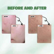 Sérum para Piel Sensible con Enrojecimiento: Ácido Azelaico 10%+ + Ácido Hialurónico (Antienflamatorio, Sin Resecamiento) - Azul Cadete - Ver 9