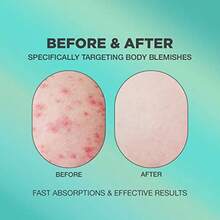 Butt Acne Cream Buttocks Acne Lotion For Body Blemishes Body Acne Cream Formulated With Natural Formula Butt Acne Clearing Treatment Lotion Butt Acne Spot Cream Targeting Stubborn Blemishesm1 - as pic - View 2