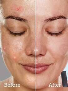 2 件面部清洁工具、面部护理刮刀、美容清洁工具、适合所有皮肤类型、男女通用的非过敏性不锈钢黑头去除工具、双头黑头钳和黑头去除套装、黑头清洁器：面部毛孔清洁器、去角质剂和按摩工具，使皮肤光滑