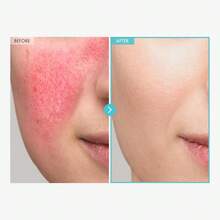 Repair And Repair Cream, Treatment, Soothing Acne, Redness, Rosacea Treatment, Skin Barrier Repair, Moisturizing, Non Comedogenic, Repair And Repair Cream - Kem Kẽm - Xem 3